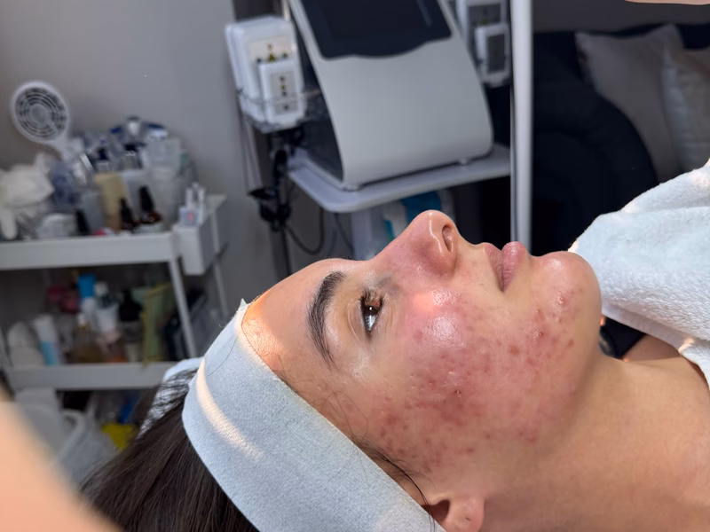 A client with active acne receiving a facial treatment